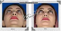 عمل بینی شماره 730