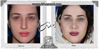 عمل بینی شماره 733