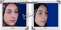 عمل بینی شماره 740