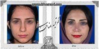 عمل بینی شماره 741