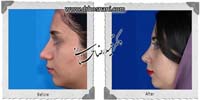 عمل بینی شماره 742