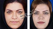 عمل بینی شماره 745
