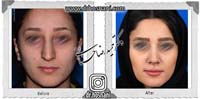 عمل بینی شماره 746