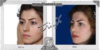  جراحی بینی -752