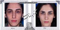  جراحی بینی -754