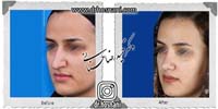 عمل بینی شماره 760