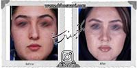 عمل بینی شماره 762