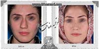 عمل بینی شماره 764