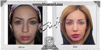 عمل بینی شماره 766