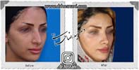 عمل بینی شماره 774