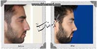  جراحی بینی -779