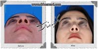  جراحی بینی -781