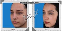 عمل بینی شماره 787