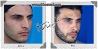 عمل بینی شماره 793