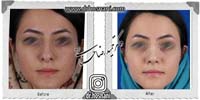 عمل بینی شماره 798