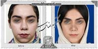 عمل بینی شماره 810