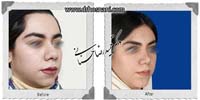 عمل بینی شماره 811