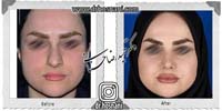 عمل بینی شماره 812