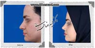 عمل بینی شماره 813