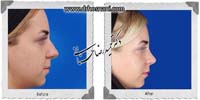  جراحی بینی -817
