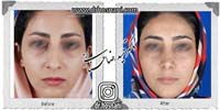  جراحی بینی -822