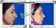  جراحی بینی -823