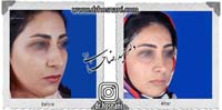  جراحی بینی -824
