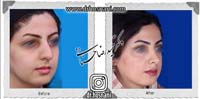 عمل بینی شماره 826