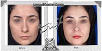 عمل بینی شماره 828