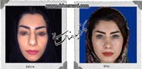عمل بینی شماره 835گوشتی با غضروف های قوی