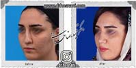  جراحی بینی -836