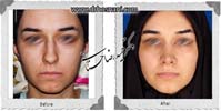 عمل بینی شماره 841