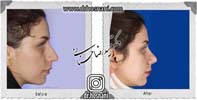 عمل بینی شماره 842