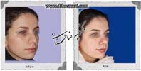 عمل بینی شماره 843