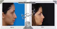  جراحی بینی -844