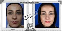 عمل بینی شماره 846