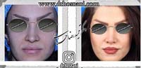 عمل بینی شماره 851