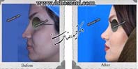 عمل بینی شماره 852