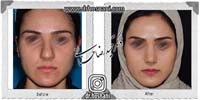 عمل بینی شماره 853