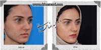  جراحی بینی -854
