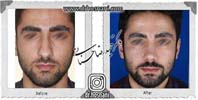 عمل بینی شماره 856
