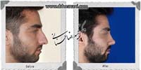 عمل بینی شماره 857