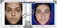 عمل بینی شماره 858