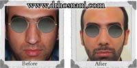  جراحی بینی -86