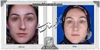 عمل بینی شماره 861
