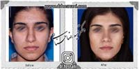 عمل بینی شماره 864