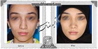 عمل بینی شماره 869