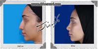 عمل بینی شماره 870