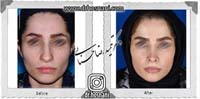 عمل بینی شماره 871
