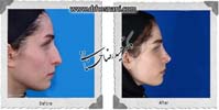 عمل بینی شماره 872